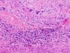 Juvenile temporal arteritis with eosinophilia in a patient with Kimura disease